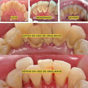 Irrigador Bucal OralWave da Loja MelhorIdeia